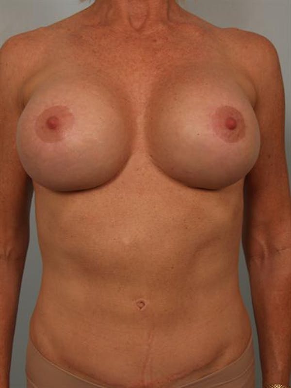 Complex Breast Revision Before & After Gallery - Patient 1310581 - Image 2