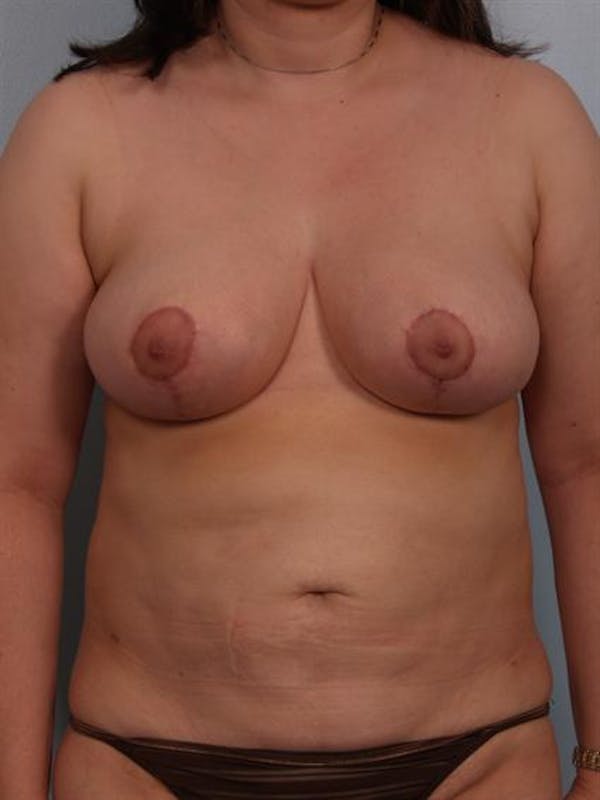 Breast Reduction Before & After Gallery - Patient 1310580 - Image 2