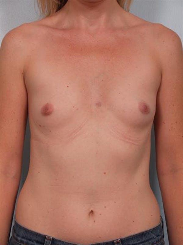 Breast Augmentation Before & After Gallery - Patient 1310582 - Image 3