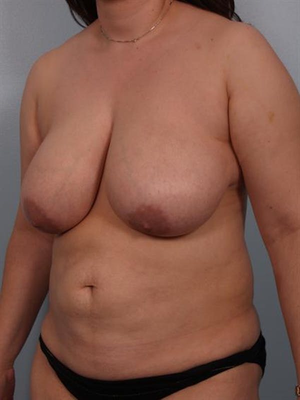 Breast Reduction Before & After Gallery - Patient 1310580 - Image 5