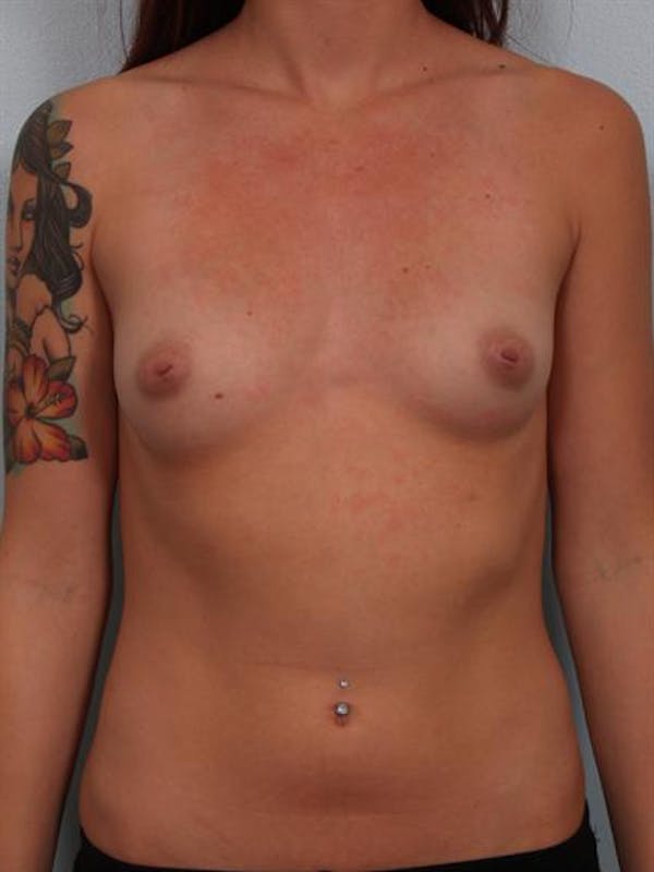 Fat Grafting Before & After Gallery - Patient 1310583 - Image 1