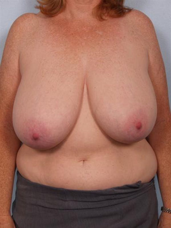 Breast Reduction Before & After Gallery - Patient 1310585 - Image 1