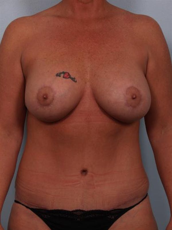 Complex Breast Revision Before & After Gallery - Patient 1310586 - Image 2