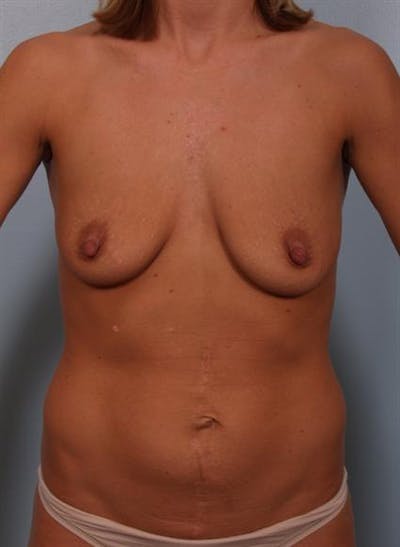 Breast Lift Before & After Gallery - Patient 1310584 - Image 1
