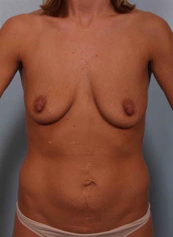 Breast Lift Gallery - Patient 1310584 - Image 1