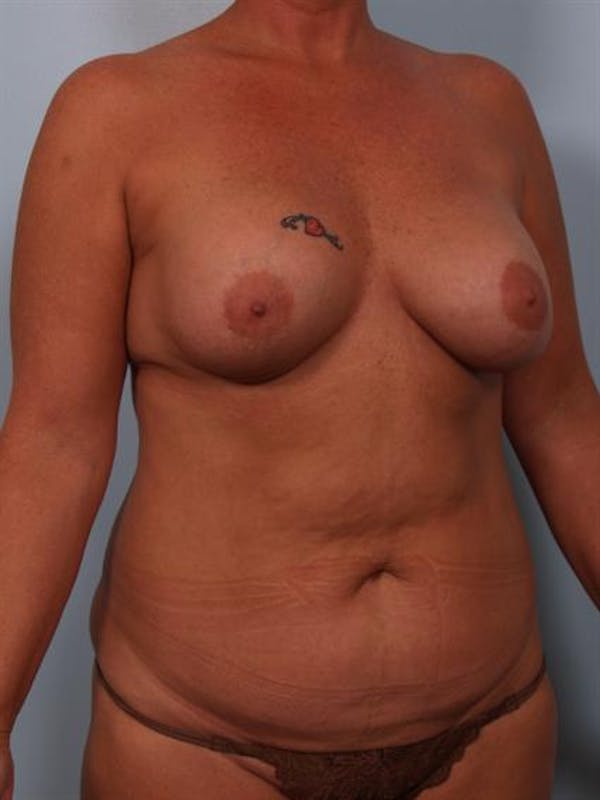 Complex Breast Revision Before & After Gallery - Patient 1310586 - Image 3