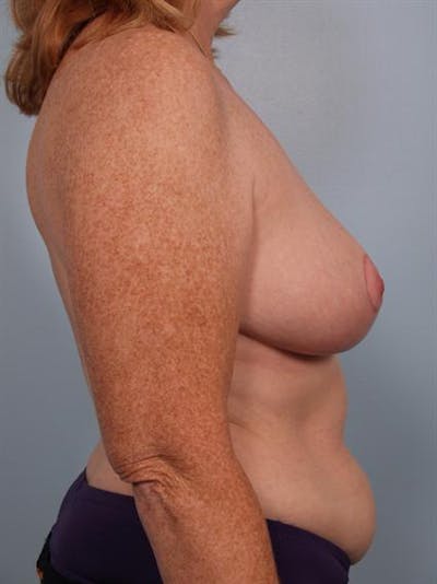 Breast Reduction Before & After Gallery - Patient 1310585 - Image 4