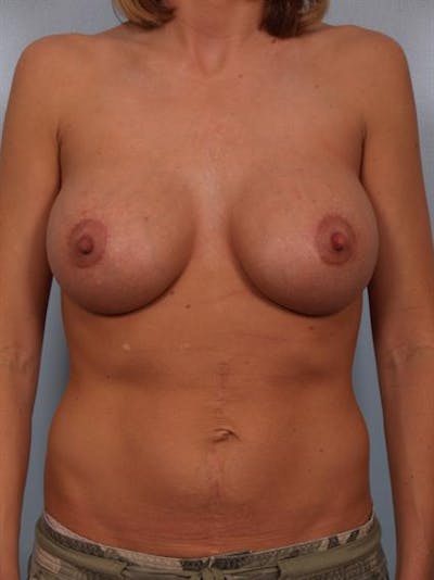 Breast Lift Before & After Gallery - Patient 1310584 - Image 2