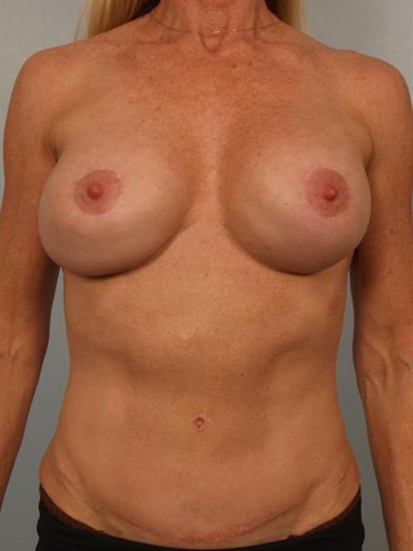 Fat Grafting Before & After Gallery - Patient 1310587 - Image 1