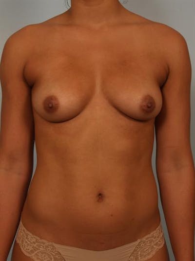 Breast Augmentation Before & After Gallery - Patient 1310588 - Image 1