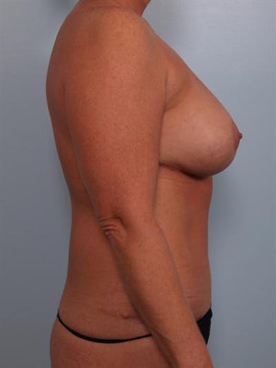 Complex Breast Revision Before & After Gallery - Patient 1310586 - Image 6