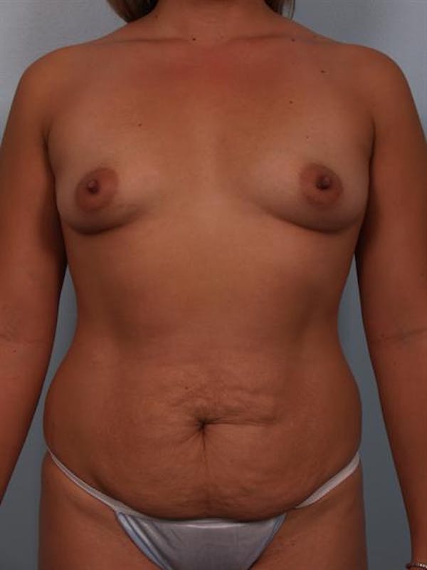 Breast Lift Gallery - Patient 1310591 - Image 1