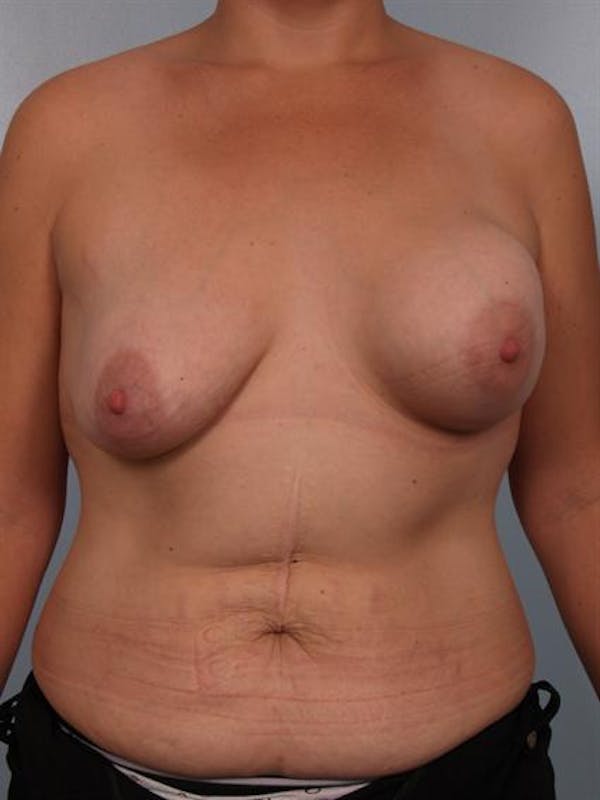 Complex Breast Revision Before & After Gallery - Patient 1310590 - Image 1