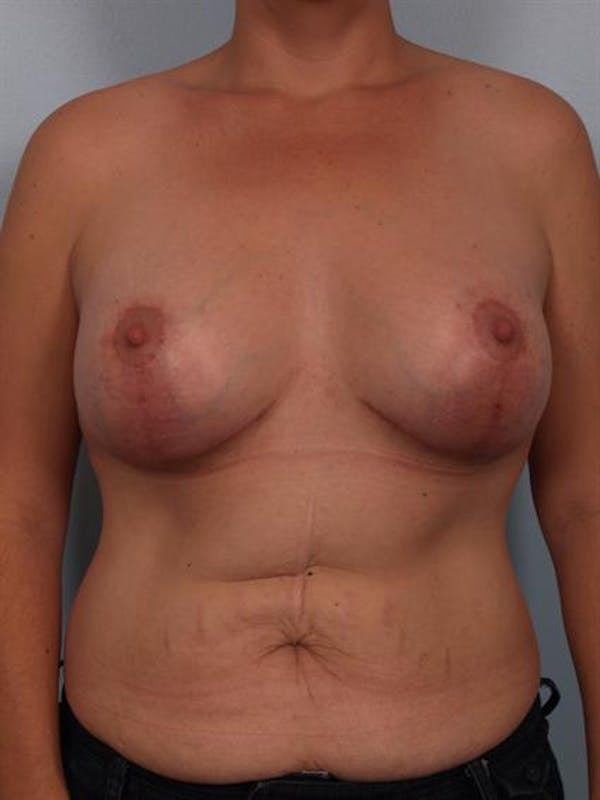 Complex Breast Revision Gallery - Patient 1310590 - Image 2
