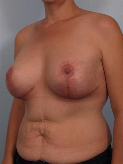 Complex Breast Revision Before & After Gallery - Patient 1310590 - Image 4