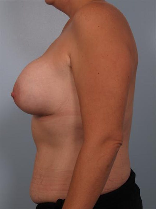 Complex Breast Revision Before & After Gallery - Patient 1310590 - Image 5