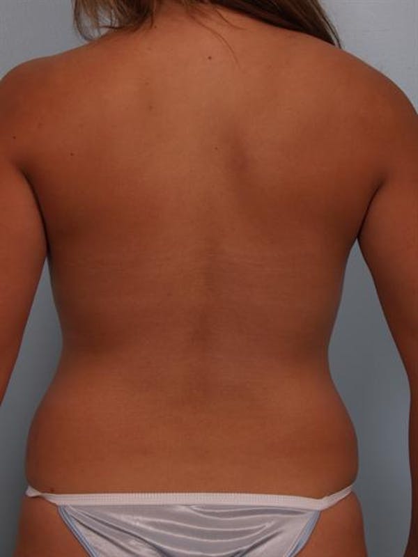 Breast Lift Before & After Gallery - Patient 1310591 - Image 7