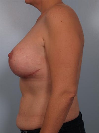 Complex Breast Revision Before & After Gallery - Patient 1310590 - Image 6