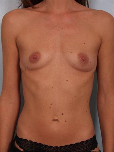 Breast Augmentation Before & After Gallery - Patient 1310597 - Image 1