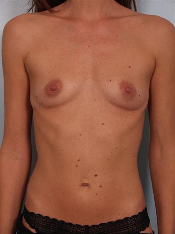 Breast Augmentation Gallery - Patient 1310597 - Image 1