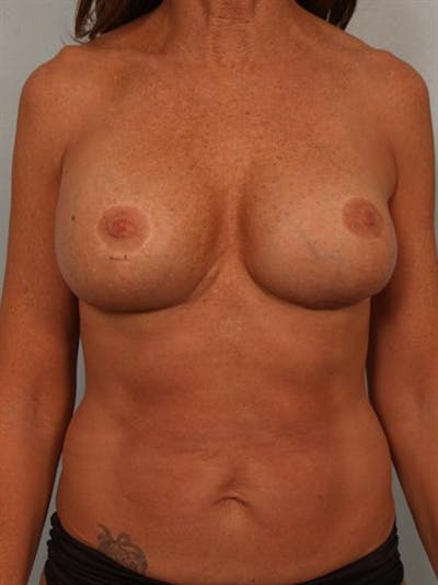 Fat Grafting Before & After Gallery - Patient 1310592 - Image 2