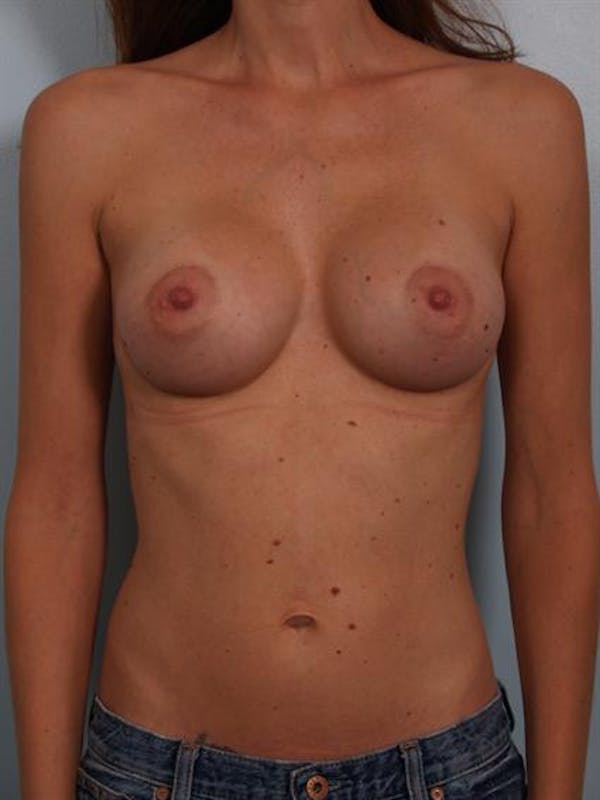 Breast Augmentation Before & After Gallery - Patient 1310597 - Image 2