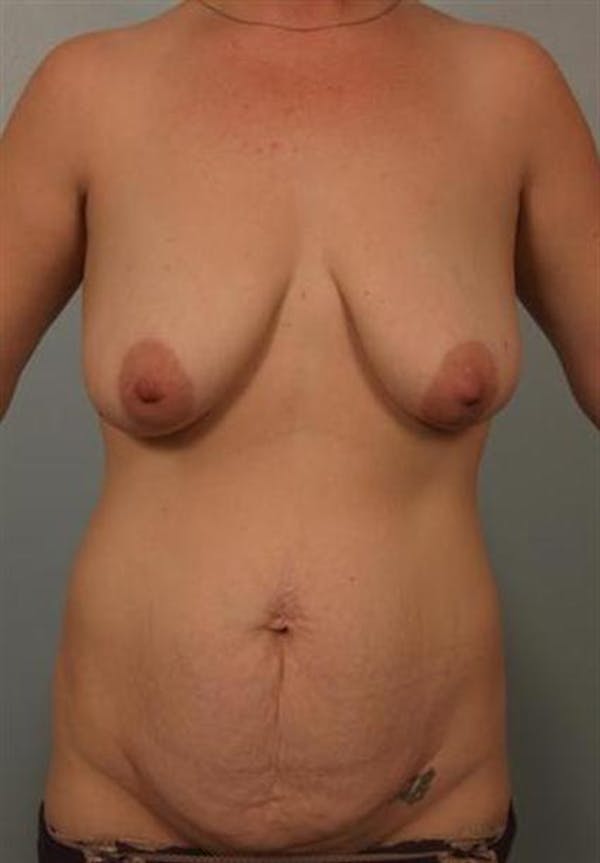 Breast Lift Gallery - Patient 1310596 - Image 1