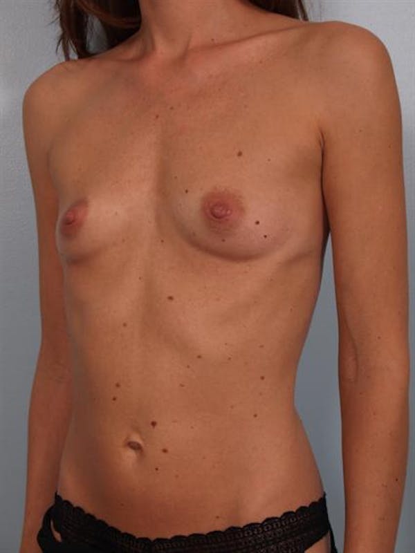 Breast Augmentation Gallery - Patient 1310597 - Image 5