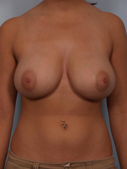 Before image of Breast Reduction by Dr. Cohen.