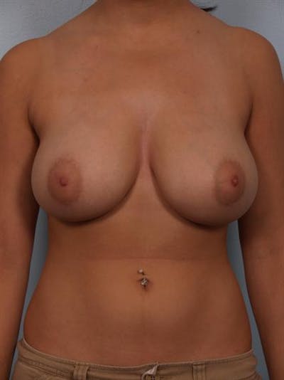 Breast Reduction Before & After Gallery - Patient 1310601 - Image 1