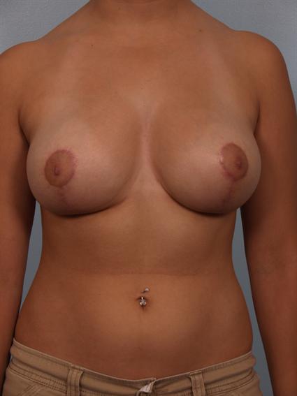 after image of Breast Reduction by Dr. Cohen.