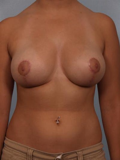 Breast Reduction Before & After Gallery - Patient 1310601 - Image 2
