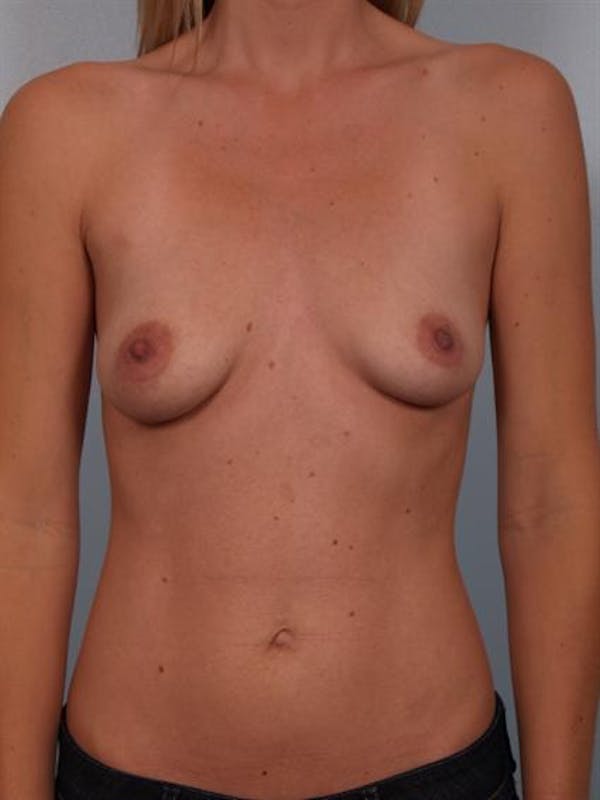 Breast Augmentation Gallery - Patient 1310606 - Image 1