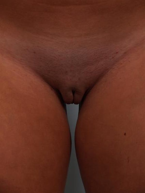 Labia Reduction Before & After Gallery - Patient 1310600 - Image 2