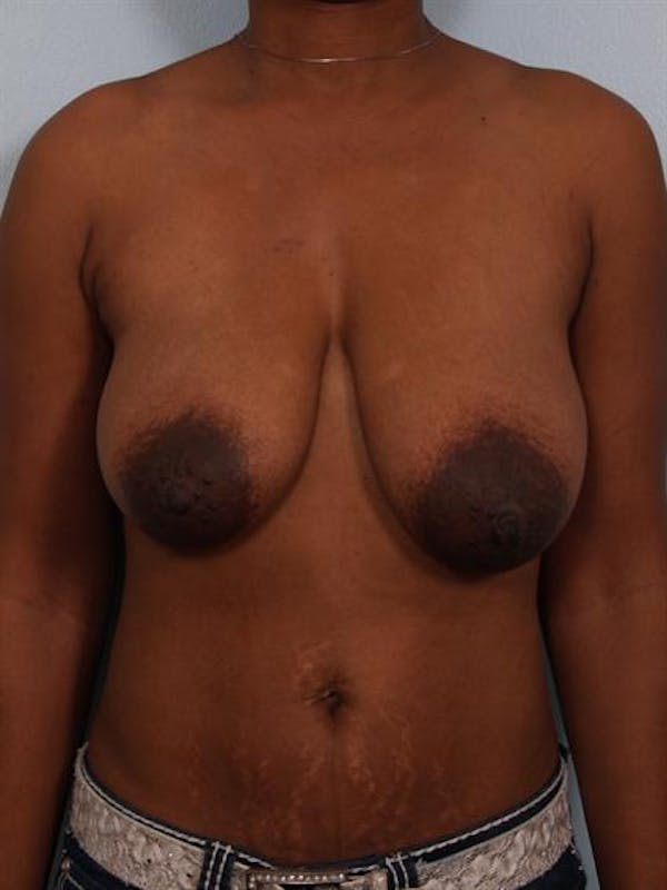 Breast Reduction Before & After Gallery - Patient 1310608 - Image 1