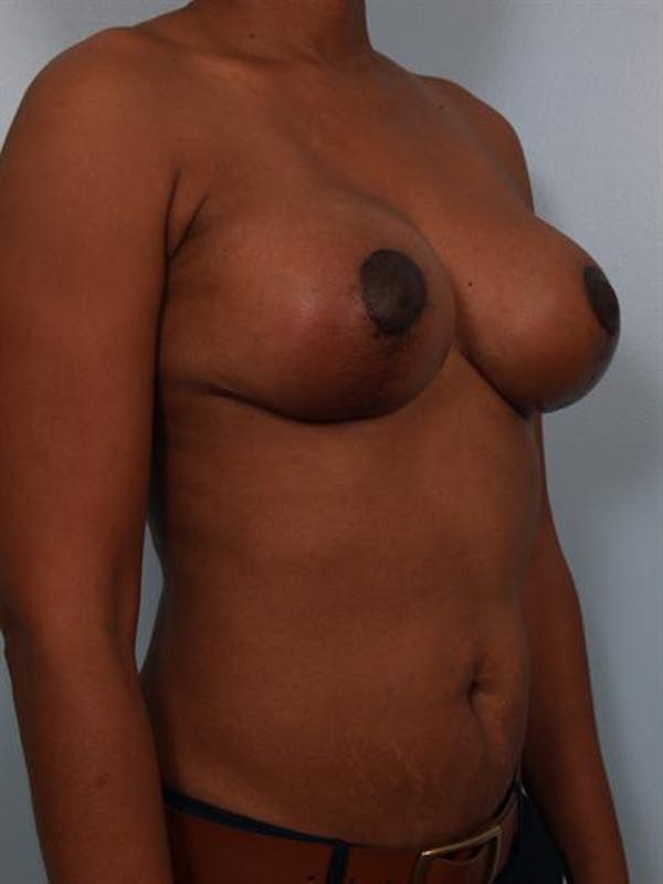 Breast Reduction Before & After Gallery - Patient 1310608 - Image 6