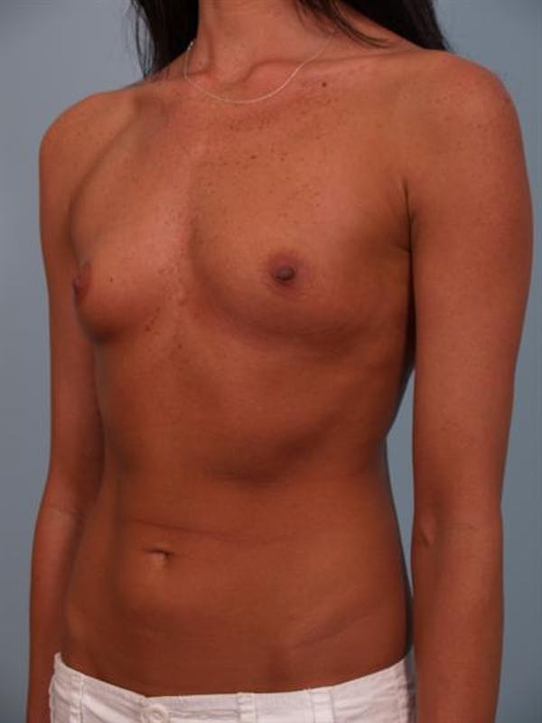 Breast Augmentation Before & After Gallery - Patient 1310617 - Image 1