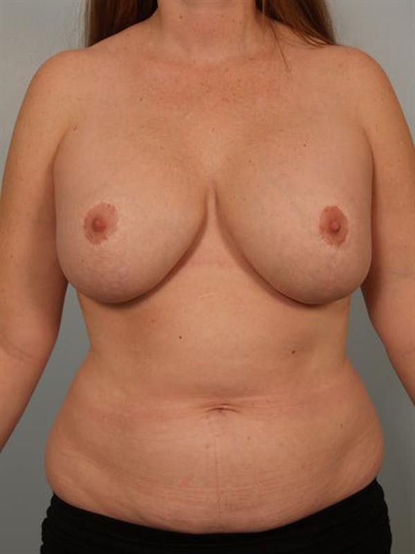 Fat Grafting Before & After Gallery - Patient 1310614 - Image 1