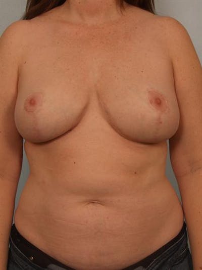 Fat Grafting Before & After Gallery - Patient 1310614 - Image 2