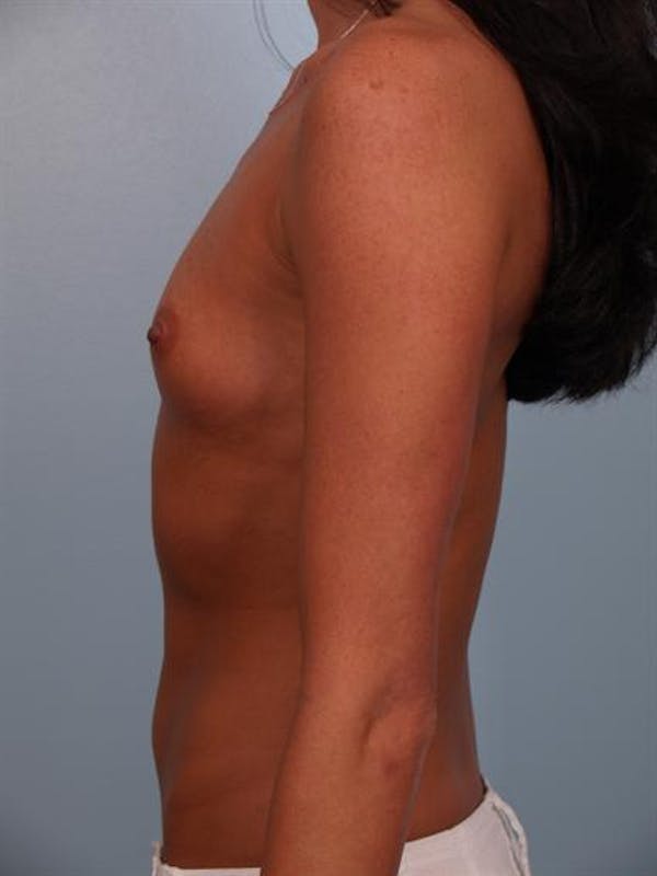 Breast Augmentation Before & After Gallery - Patient 1310617 - Image 3