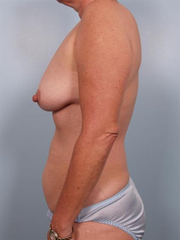 Breast Lift Before & After Gallery - Patient 1310616 - Image 3