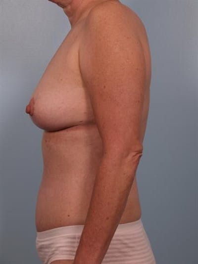 Breast Lift Before & After Gallery - Patient 1310616 - Image 4