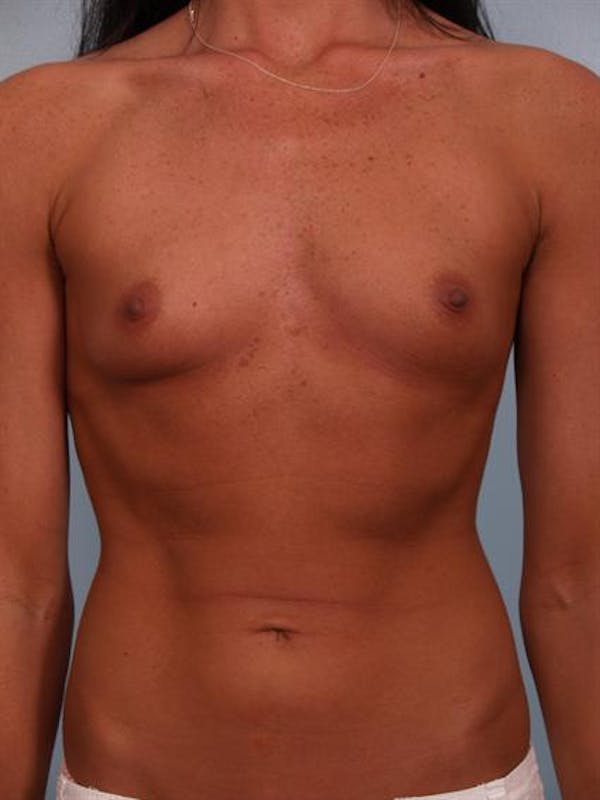 Breast Augmentation Before & After Gallery - Patient 1310617 - Image 5