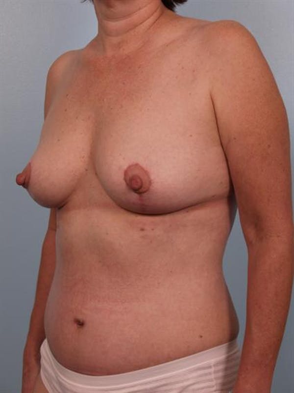 Breast Lift Before & After Gallery - Patient 1310616 - Image 2