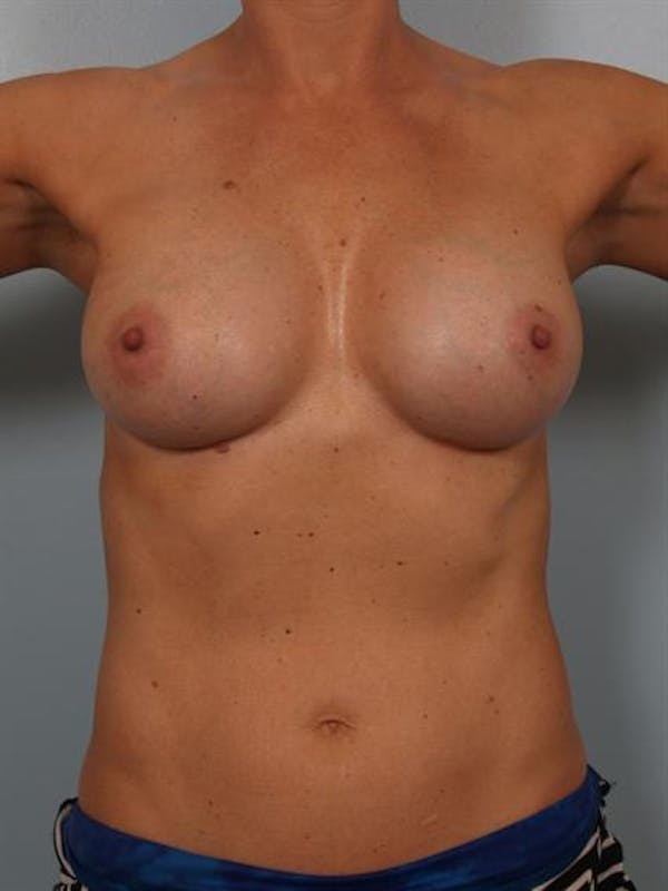 Complex Breast Revision Gallery - Patient 1310619 - Image 4