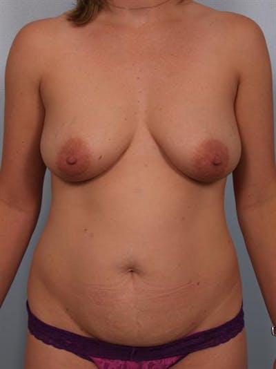 Breast Lift Gallery - Patient 1310624 - Image 1