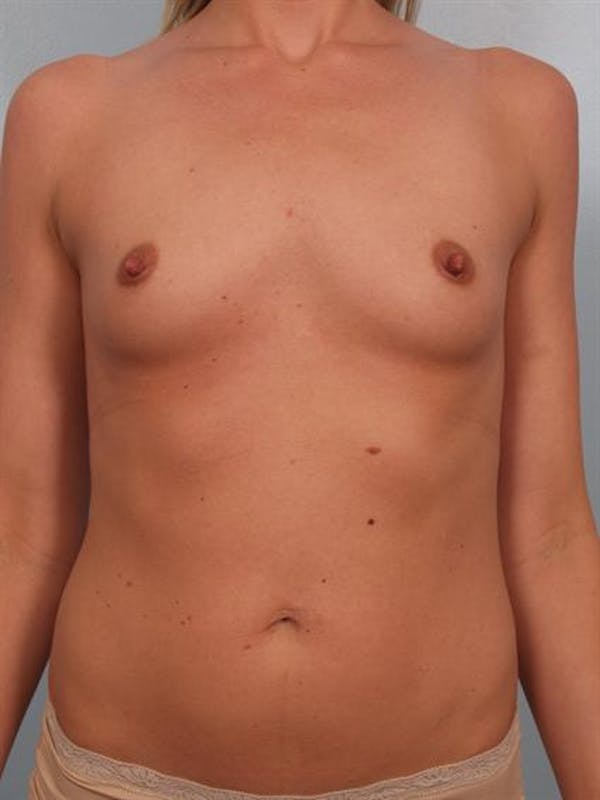 Breast Augmentation Before & After Gallery - Patient 1310626 - Image 1