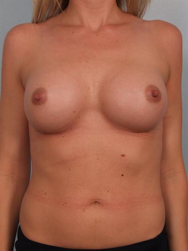 Breast Augmentation Gallery - Patient 1310626 - Image 2