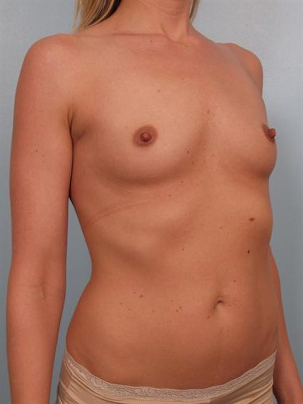 Breast Augmentation Before & After Gallery - Patient 1310626 - Image 3