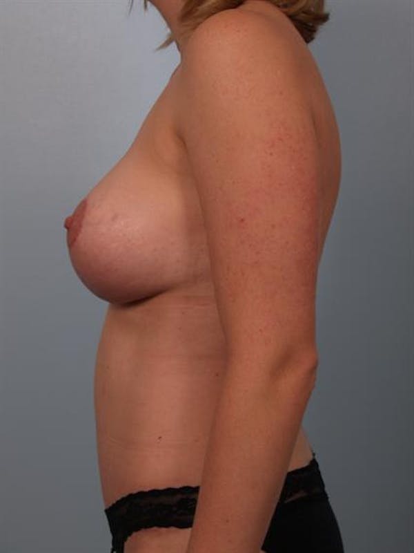 Breast Lift Before & After Gallery - Patient 1310624 - Image 6